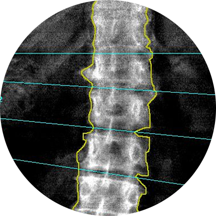 Bone Density Scan Image