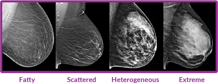 Types of Breast Tissue